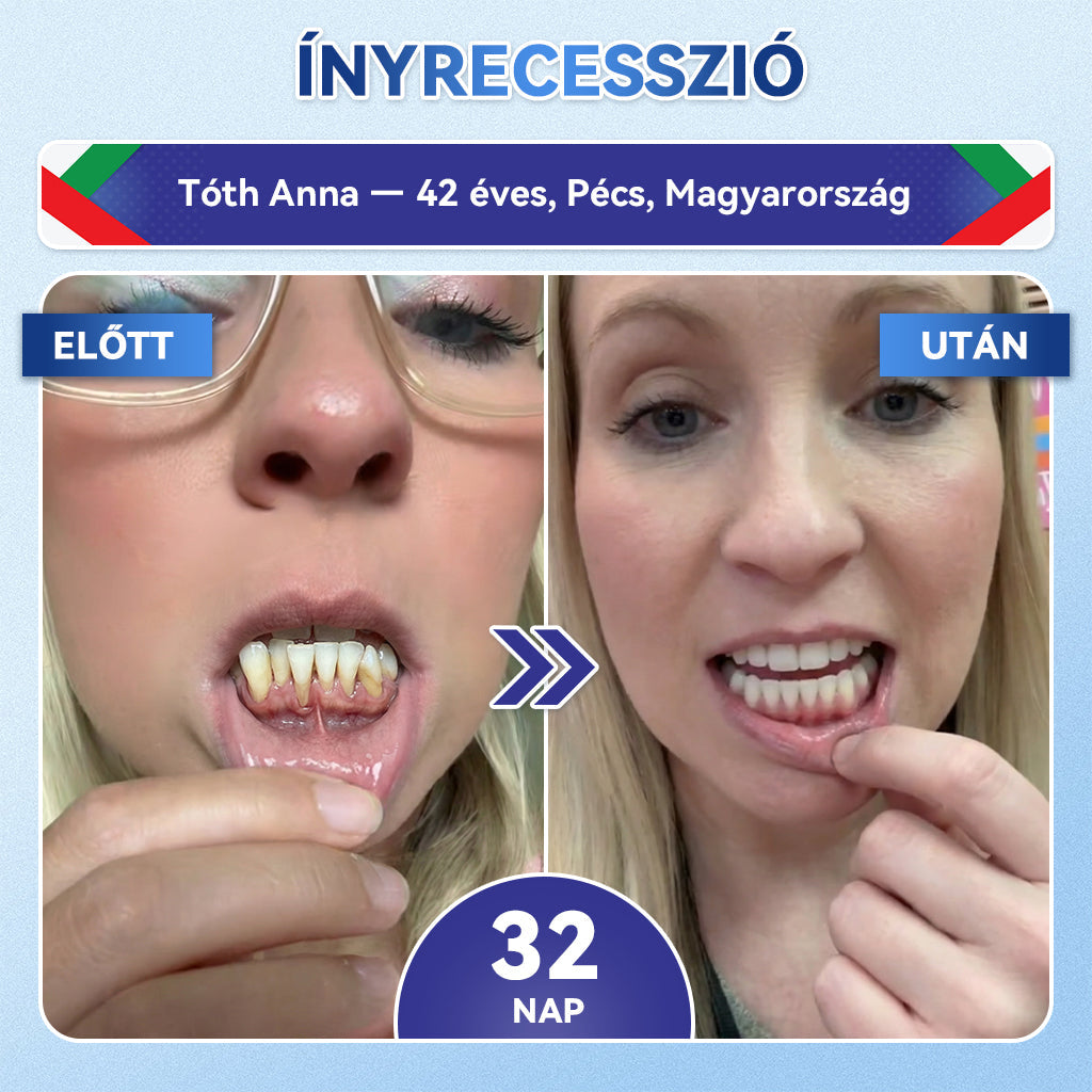 🦷𝐆𝐥𝐢𝐦𝐦𝐞𝐫𝐥𝐲®😁  Tideglusib Fog & íny Javító mikrotűs tapasz | Fejlett őssejt-aktiváló fogcsíkok (újjáépíti a fogzománcot és a dentint • erősíti az ínyt • megszünteti a fogkövet és a szagokat • megállítja a fogérzékenységet)) 3.0-🌿