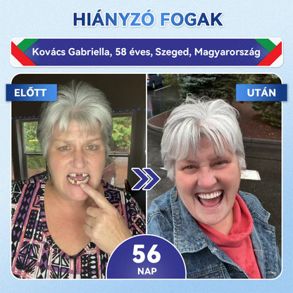 🦷𝐆𝐥𝐢𝐦𝐦𝐞𝐫𝐥𝐲®😁  Tideglusib Fog & íny Javító mikrotűs tapasz | Fejlett őssejt-aktiváló fogcsíkok (újjáépíti a fogzománcot és a dentint • erősíti az ínyt • megszünteti a fogkövet és a szagokat • megállítja a fogérzékenységet)) 3.0-🌿