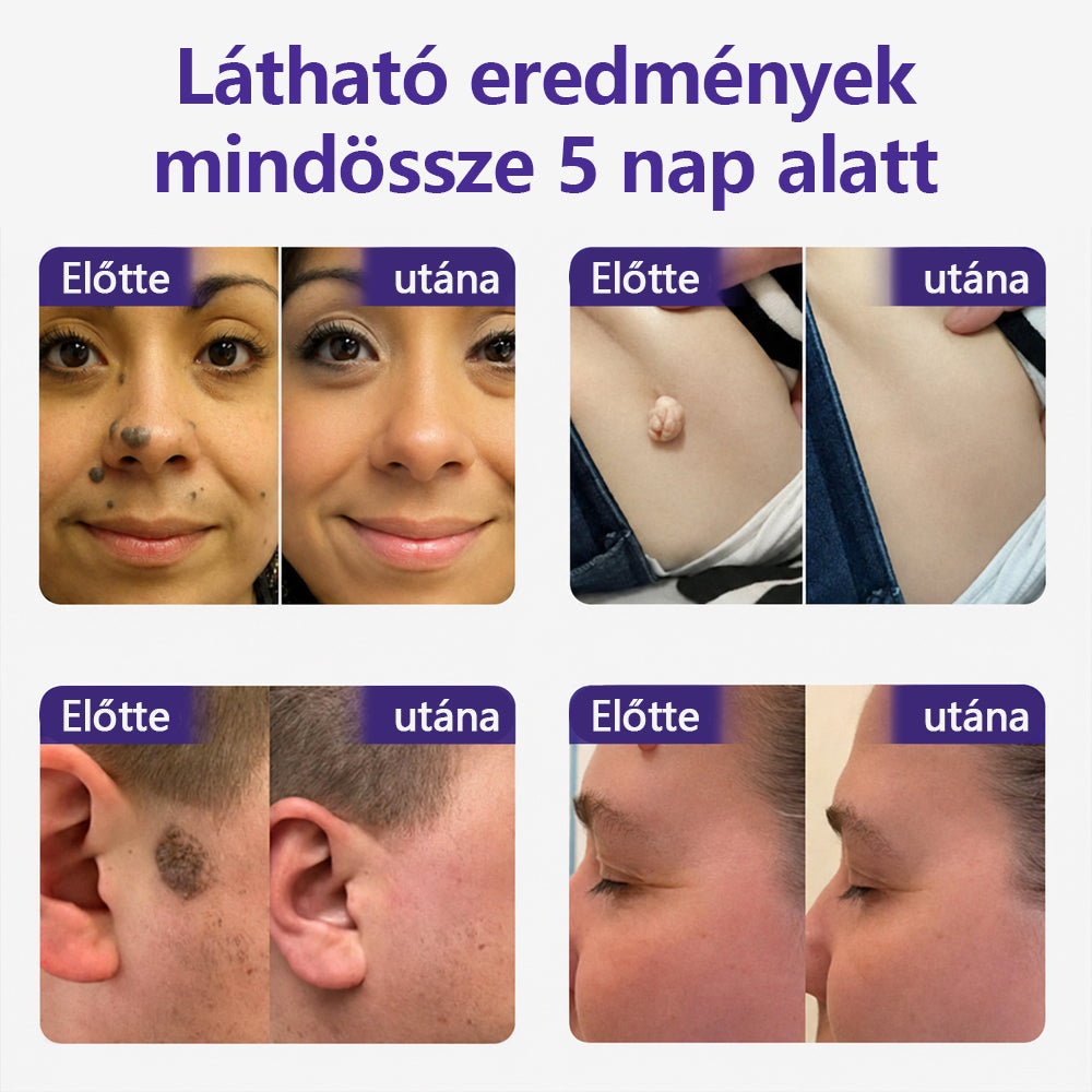 👩🏻‍⚕️COLTURE® szemölcs- és anyajegytávolító mikrotűs tapasz-🔥