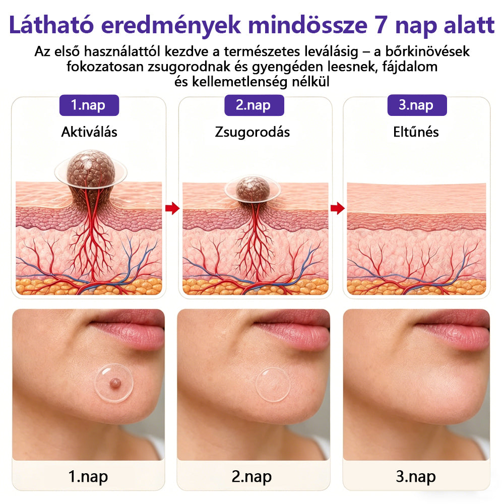 👩🏻‍⚕️COLTURE® szemölcs- és anyajegytávolító mikrotűs tapasz-🔥